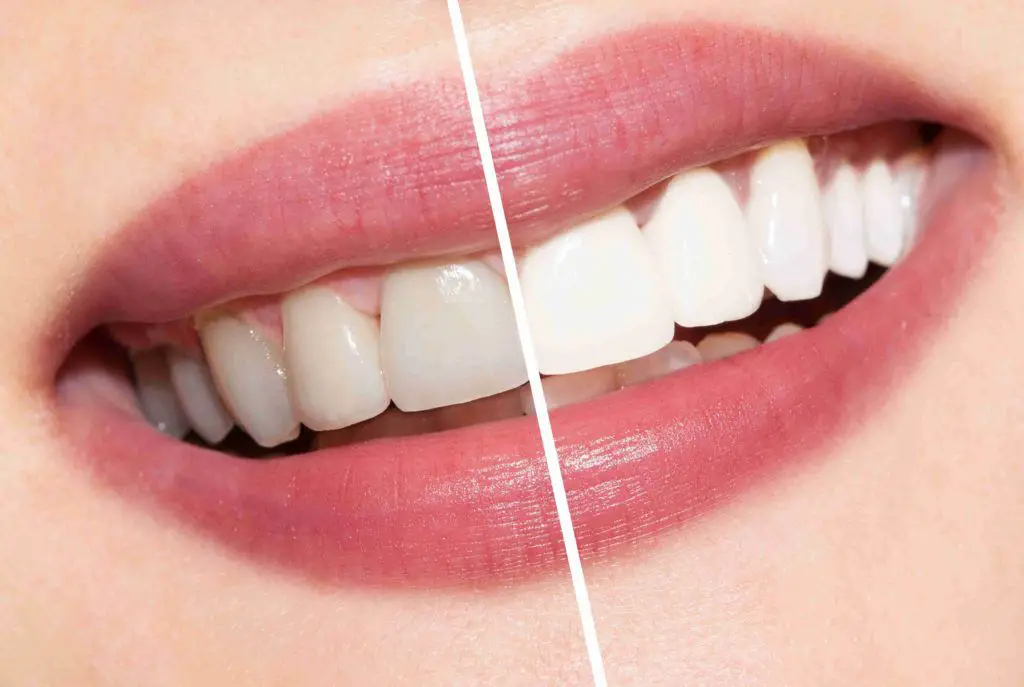 when-little-things-mean-a-lot-the-pros-and-cons-of-teeth-whitening