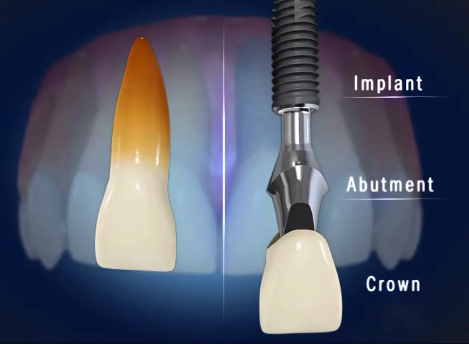 Dental Implant Procedure - DentalsReview