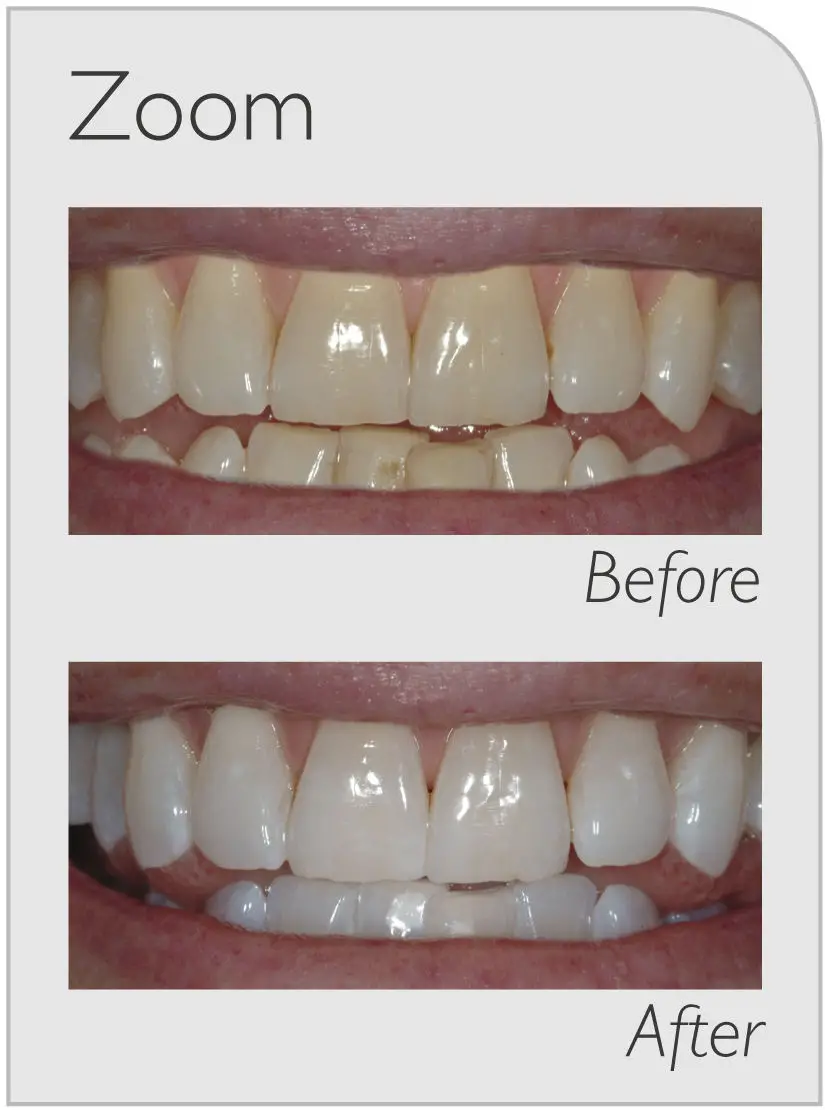 before and after zoom whitening