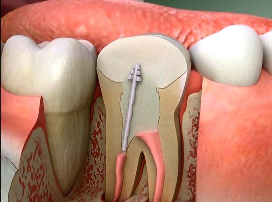 signs-that-you-need-a-root-canal-treatment-dentalsreview